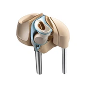 Αντικατάσταση Γόνατος Αρθρίτιδας